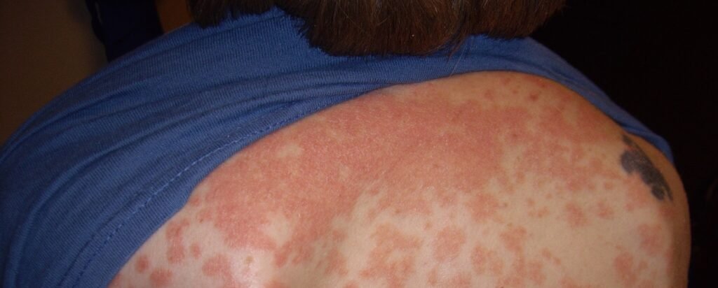 Skin health, autoimmune conditions: Psoriasis